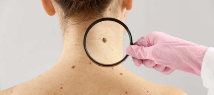 Skin Cancer Spreads through Body via Trail, study