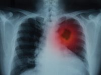 Self-Destruct Trigger in Lung Cancer Cells Identified