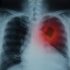 Self-Destruct Trigger in Lung Cancer Cells Identified