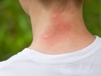 Ever Wonder Why you’re So Prone to Mosquito Bites?