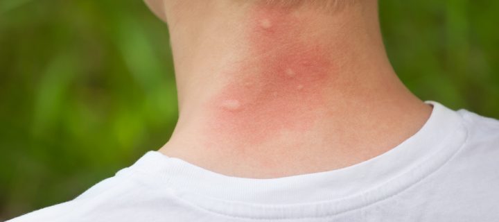 Ever Wonder Why you’re So Prone to Mosquito Bites?