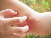 What You Need To Know About Bug Bites