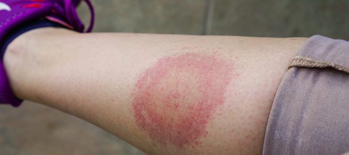 Lyme Disease cases up 320% in the U.S.