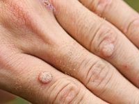 5 Surefire Ways to Get Warts And How to Deal With Them
