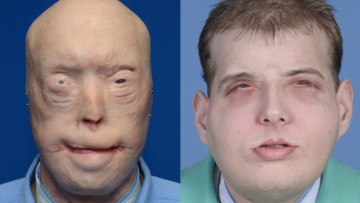 face-transplant