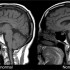 This Youngest Professor Ever at the Mayo Clinic has Identified New Landmark Genetic Causes for Dementia