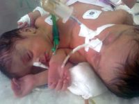 Conjoined Twins Separated in Marathon Surgery
