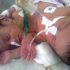 Conjoined Twins Separated in Marathon Surgery