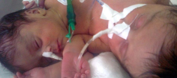 Conjoined Twins Separated in Marathon Surgery