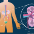 More Than 17% of Donated Kidneys Are Thrown Away. Here’s Why