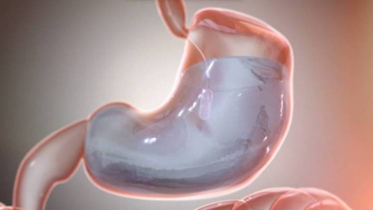 The system, designed by San Diego firm Obalon Therapeutics, allows a gastric balloon to be inserted into the stomach without invasive surgery. The balloon is being launched in the UK after successful trials here and in the US. What makes this system different from other gastric balloons is that it can be swallowed and then inflated without the need for anaesthetic or sedation. It is packed inside a gelatine capsule that dissolves in the stomach and is inflated through a tube. Then the tube is pulled out, allowing a self-sealing valve to keep the balloon inflated. Two or even three balloons could be placed in the patient's stomach, and after three months they are removed using a traditional endoscopic procedure. The balloon works by taking up space in the stomach, making the patient feel fuller after eating a reduced portion of food, and so reducing their calorific intake. Picture: Universal News And Sport (Scotland) 21 January 2014.