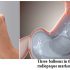 The FDA Just Approved These Balloons that You Swallow to Lose Weight