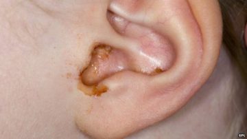 cleaning-wax-in-ears