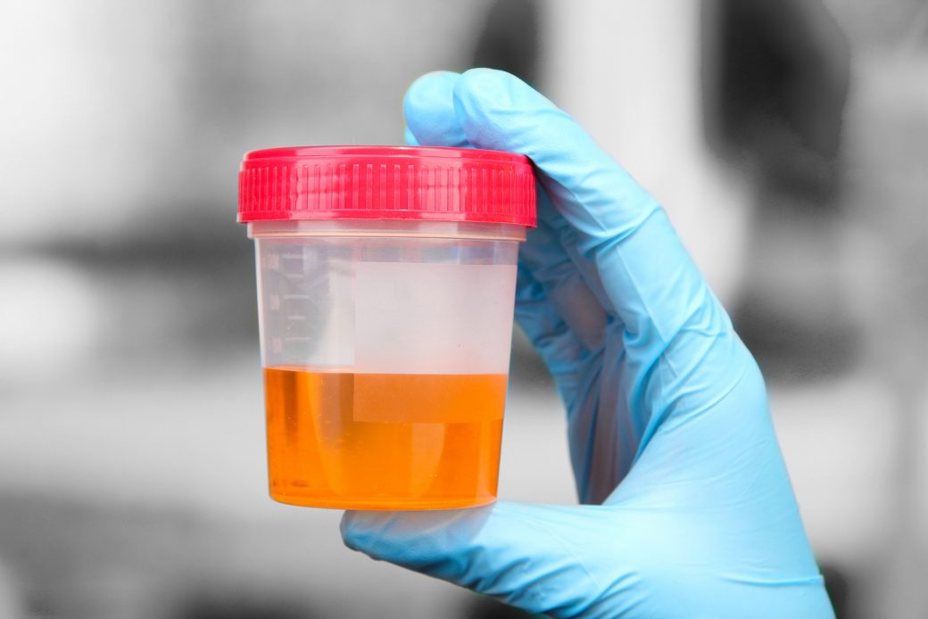 Medical-urine-test-for-nutrition