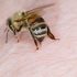 5 Ways to Treat a Bee Sting