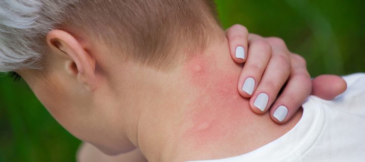 These 10 Diseases and Conditions Are Associated With Psoriasis