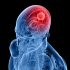 Not Funny? This Brain Injury Affects Your Sense of Humor