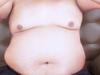 What is Gynecomastia and How to Fix It