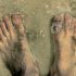 Australian Teen Has His Legs Munched on by Sea Fleas in a Freak Occurrence