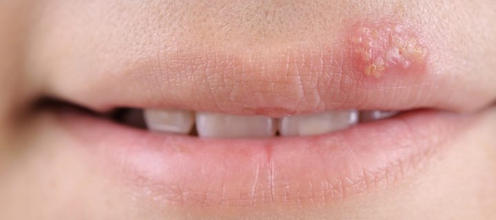 6 Ways to Get Rid of Cold Sores in a Few Days