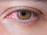 How to Treat Pink Eye