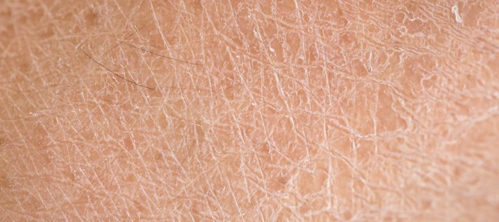 The 7 Best Ways to Treat Itchy, Dry Skin