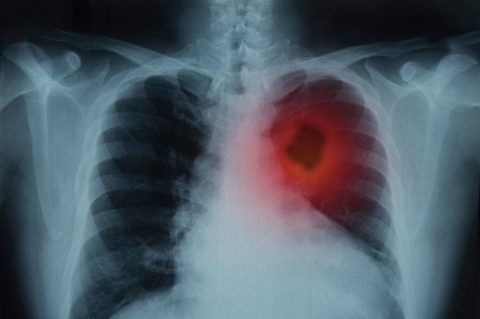 Too Much of These Popular Vitamins Dramatically Increases Lung Cancer in Some Men