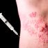This New Shingles Vaccine is Amazingly Effective, According to Experts