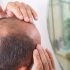 Is Your Early Balding a Warning Sign Pointing to Heart Disease?