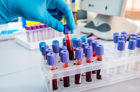 New Blood Test Detects Cancer In Early Stages