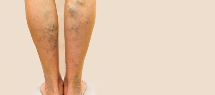 Spider Veins: What Causes Them and How to Deal With Them