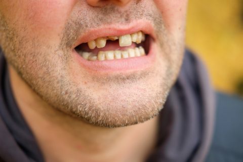 Here’s How Losing Your Teeth in Middle Age is Almost Always Comes With Other Health Problems