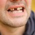Here&#8217;s How Losing Your Teeth in Middle Age is Almost Always Comes With Other Health Problems