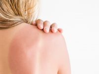 How to Best Treat Your Sunburn