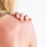 How to Best Treat Your Sunburn
