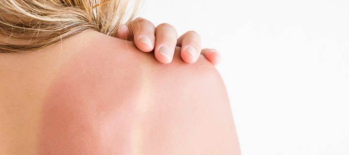 How to Best Treat Your Sunburn