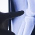 Suffering from Arthritis? A Total Hip or Knee Replacement Can Significantly Improve Your Sex Life