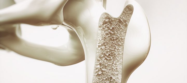 How Young Can Osteoporosis Strike?
