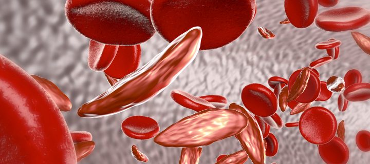 5 (Or More) Things You Didn’t Know About Sickle Cell Anemia