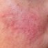 Avoid These 6 Triggers for Rosacea