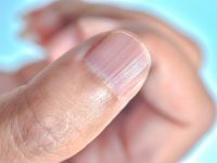 Have Ridges on Your Fingernails? This is What They Mean
