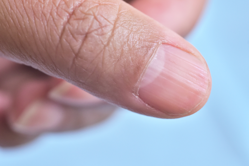 Have Ridges on Your Fingernails? This is What They MeanRateMDs Health News