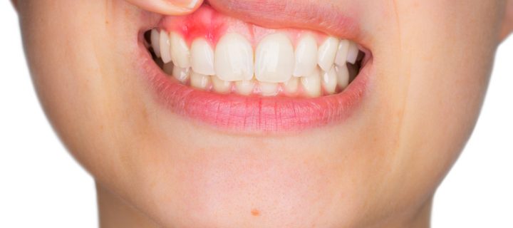 Gum Disease and the Coronavirus