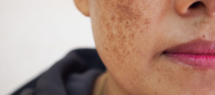 Do you have an uneven skin tone? It might be melasma