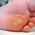 Why You Get Warts in Summer
