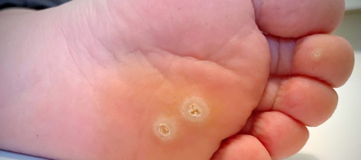 Why You Get Warts in Summer